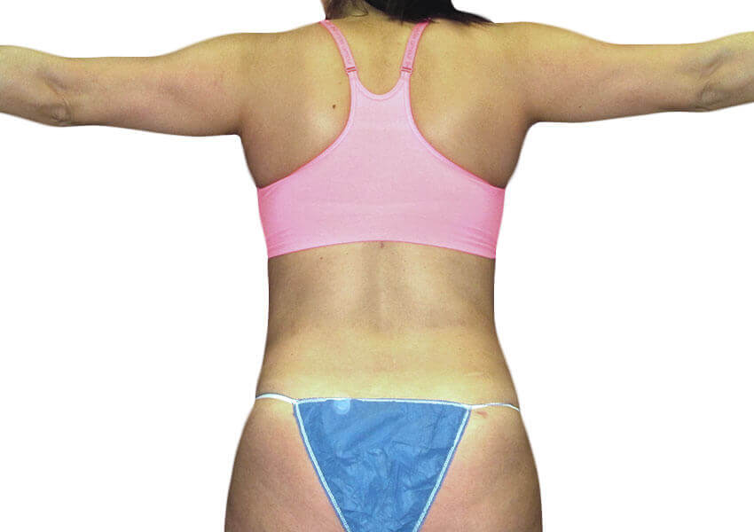 Fat Transfer to Buttocks: What You Should Know Before You Decide