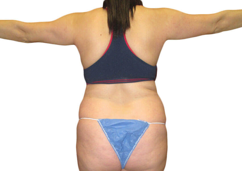 Study Confirms What Women Know: Tummy Tuck + Liposuction = Extreme  Satisfaction - Houston, Texas