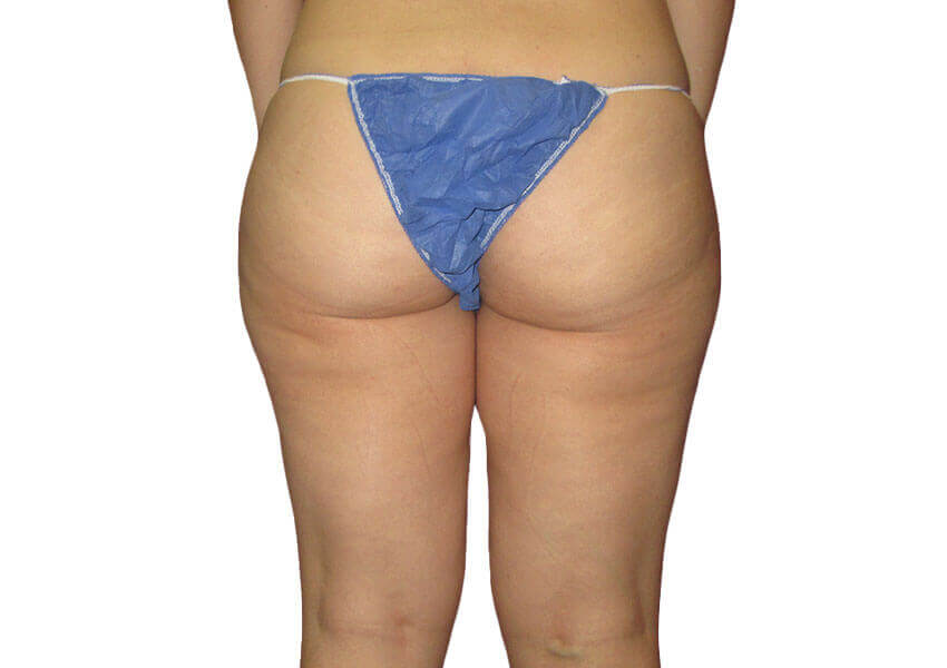 5 Things You Need to Know About Thigh Liposuction - Houston Lipo