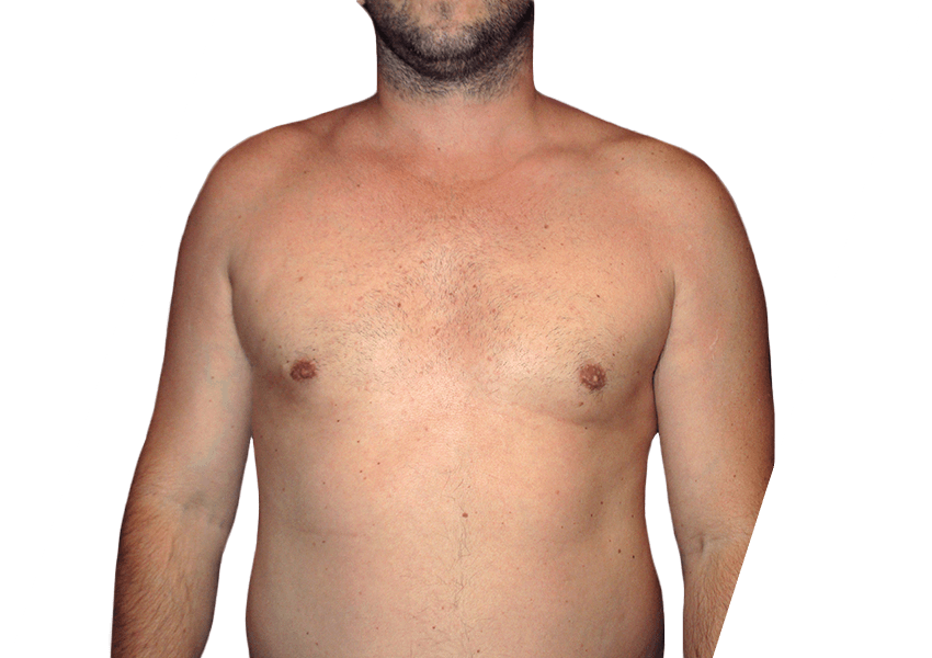 Liposuction for Men Houston TX  Male Liposuction – Houston Lipo Center