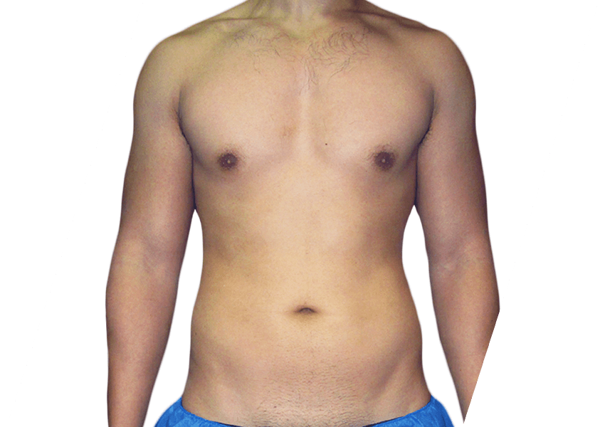 VASER High-Def Lipo in Houston  High-Definition Body Contouring