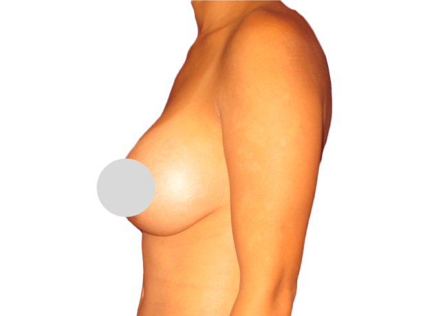 Breast Augmentation Surgery Breast Augmentation Surgery