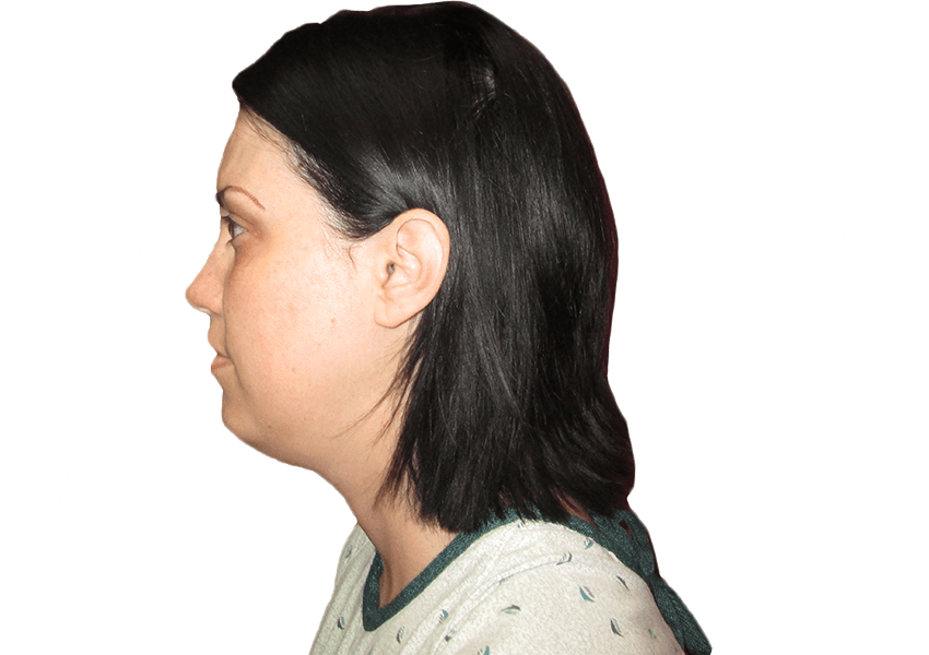 Neck Lift Before and After | Premiere Surgical Arts Houston, Texas