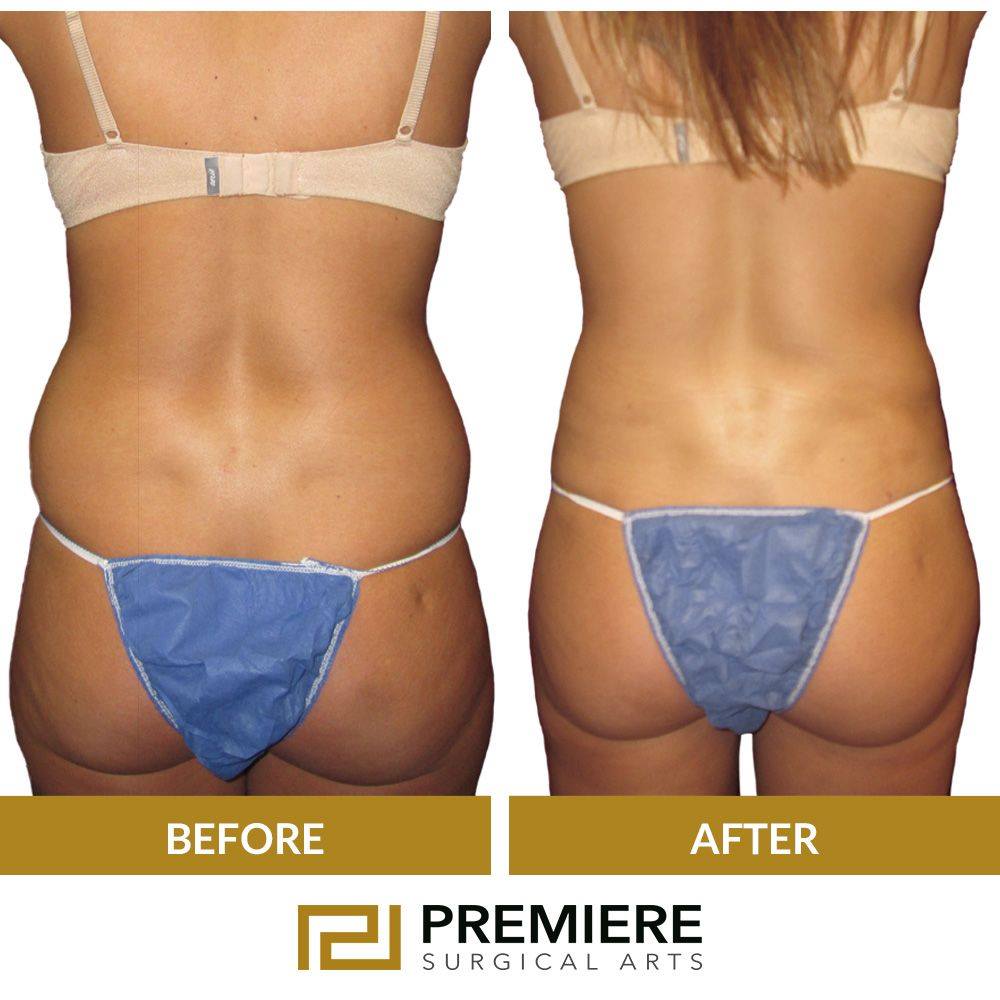 How Do Bum Implants and Brazilian Butt Lifts Work?