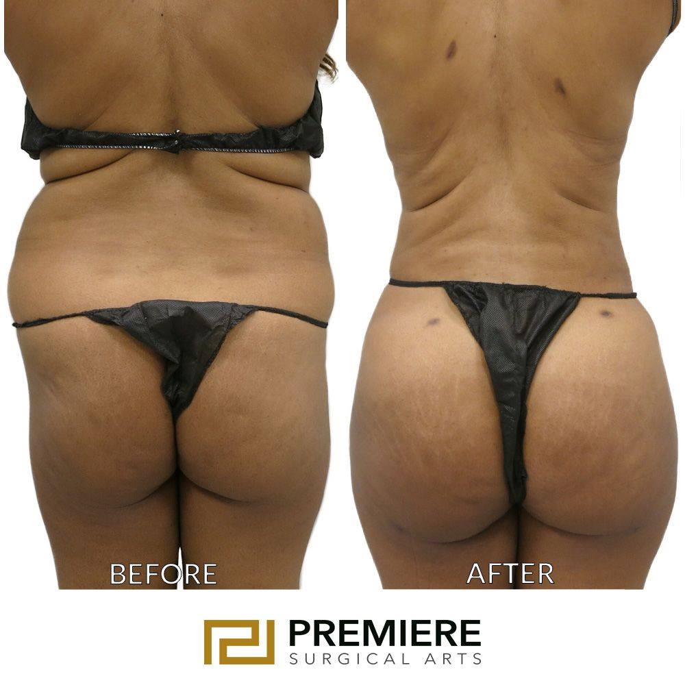 What Is a Butt Lift and Who Should Consider It?: Precision Plastic Surgery:  Plastic Surgeons