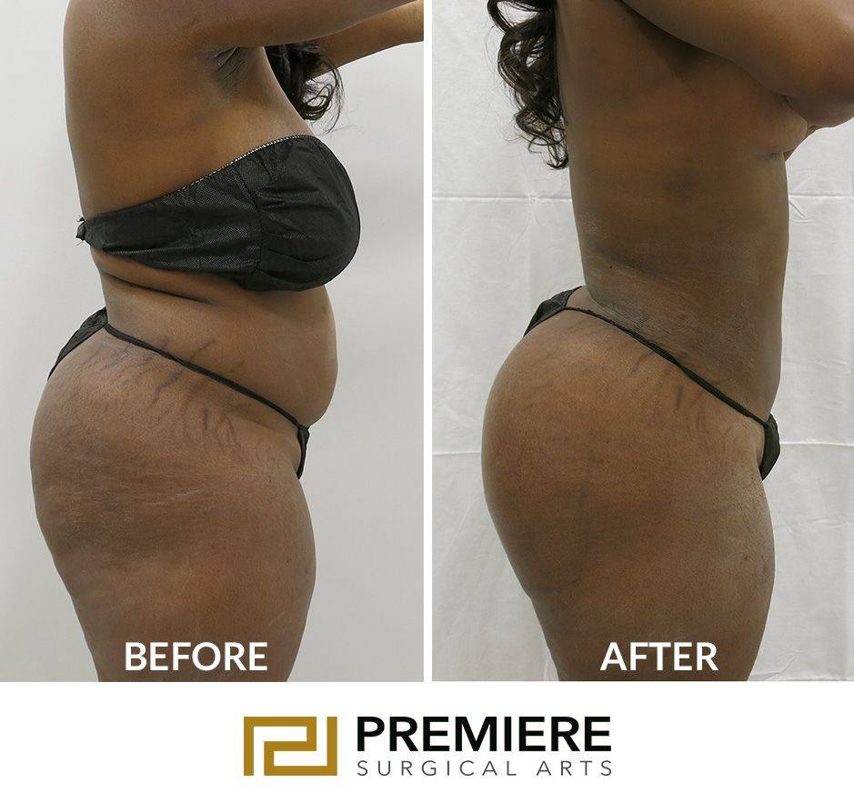 Get Your Dreamy Body Before Summer! Hip dip filling using safe injection of  body fillers to enhance and contour your shape and compliment