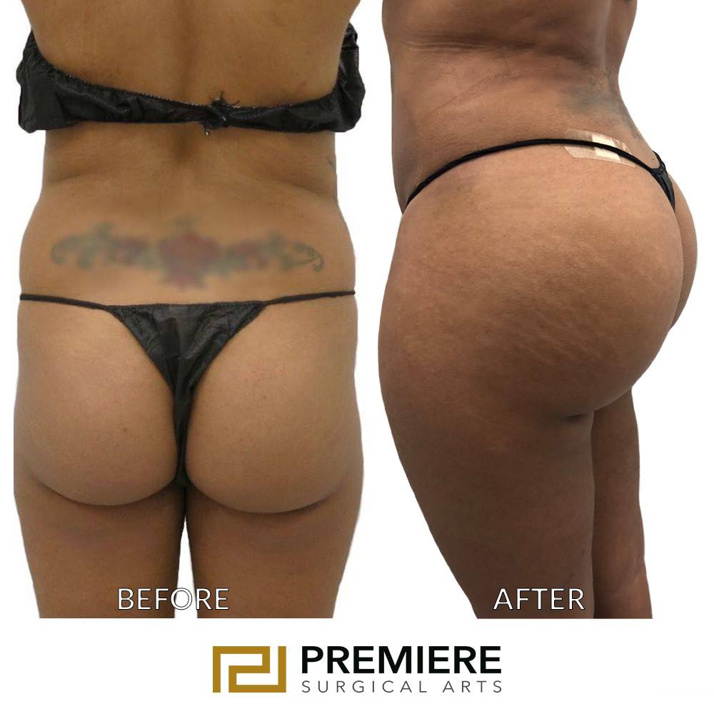 brazilian butt lift surgery cost 