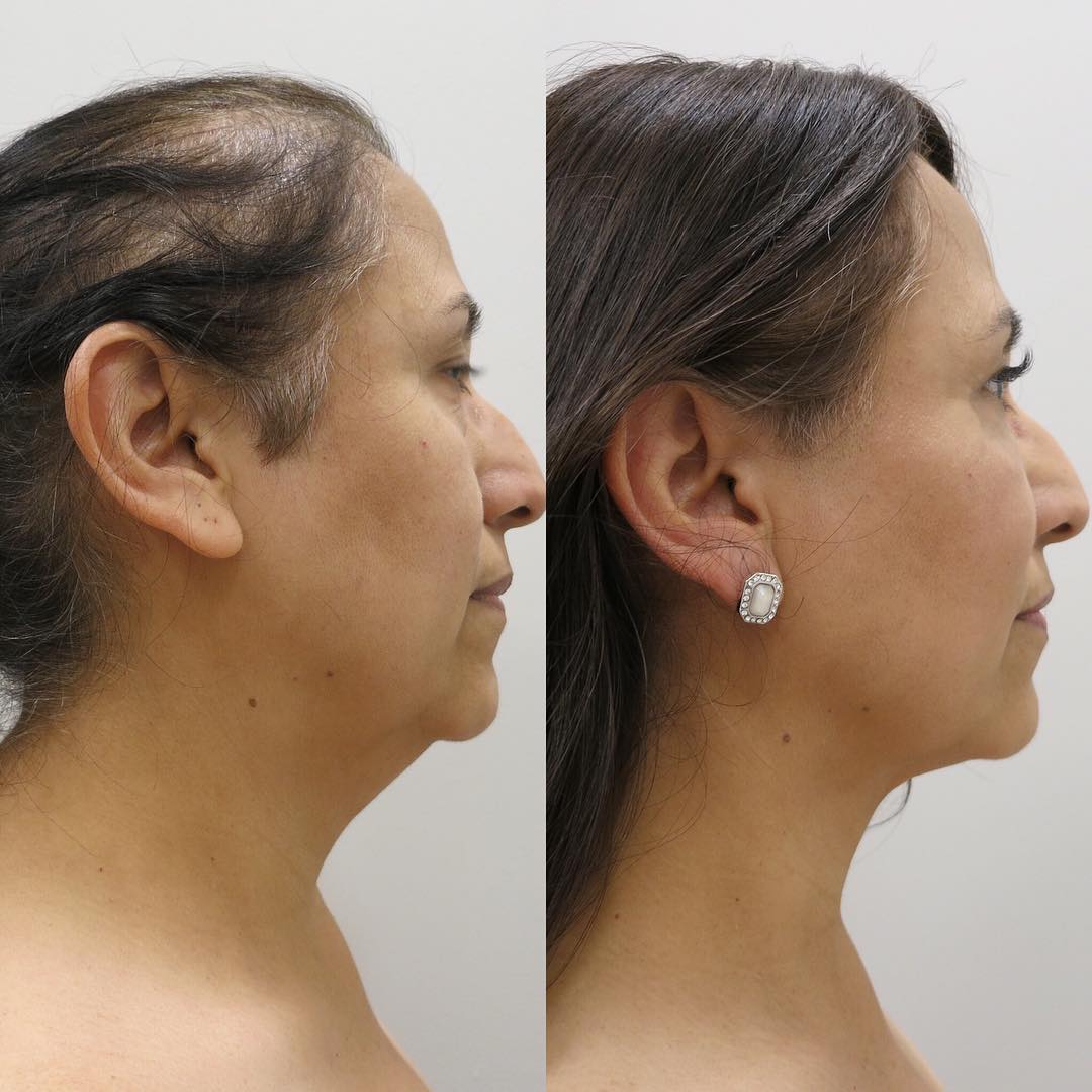 How Much Does a Neck Liposuction Cost Premiere Surgical Art