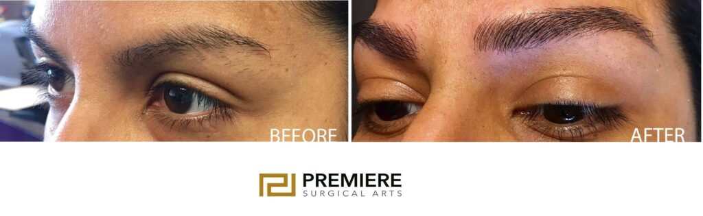 Brow Lift Before And After Surgery