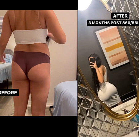 Bbl It Arms 4d Silk Etch